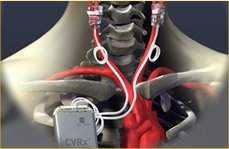 Aparelho implantvel consegue fazer controle da presso sangnea