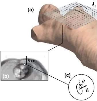 Implantes mdicos vo trocar baterias por eletricidade sem fios