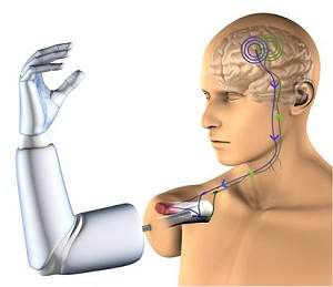 Primeiro implante de uma prtese robtica controlada pelo pensamento